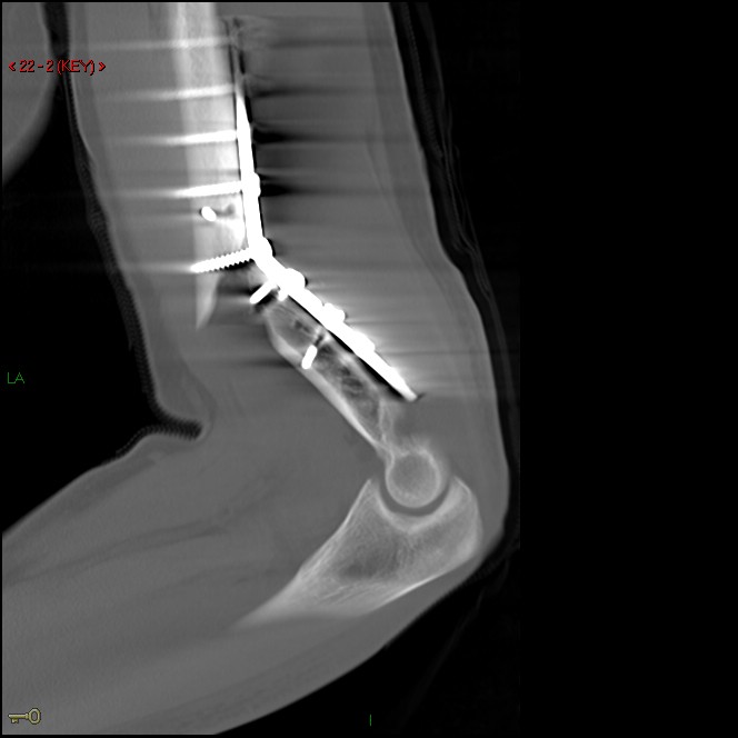 Figure 5 for case Re-fracture distal humerus